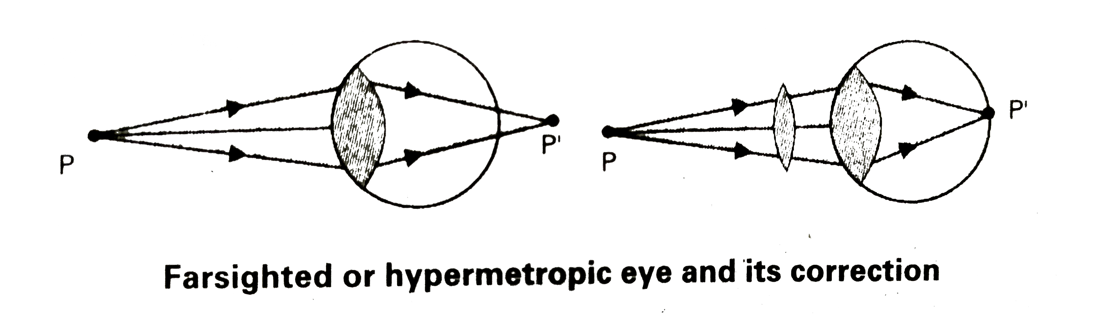 What is hypermetropia ? How can it be corrected ? - Sarthaks eConnect | Largest Online Education Community