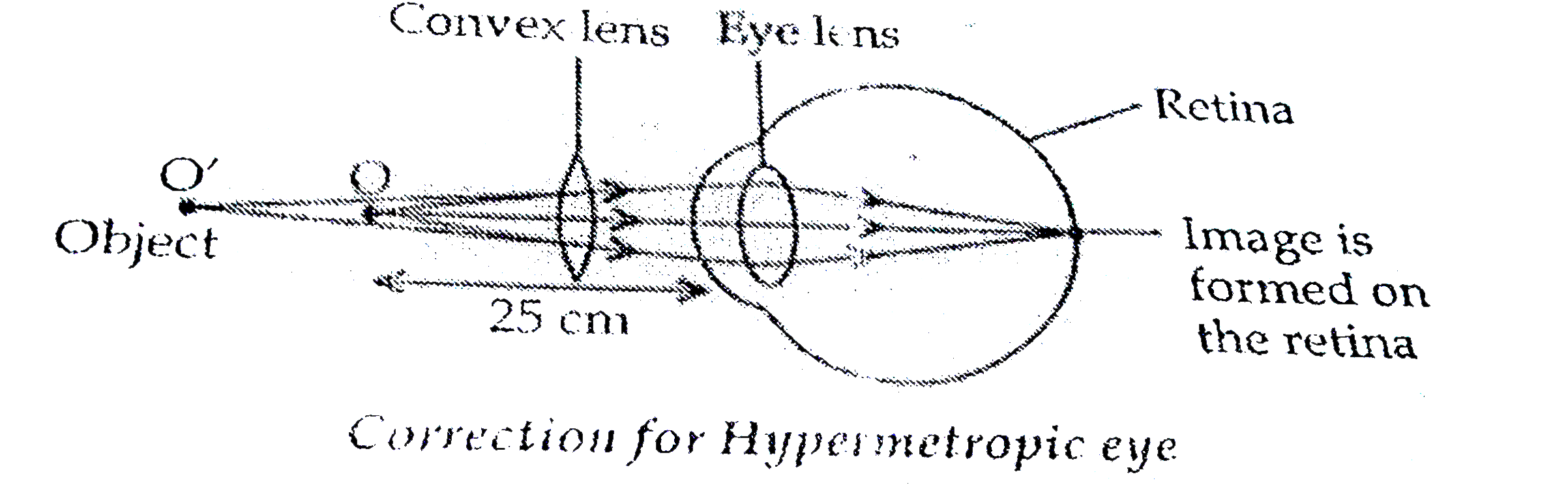 A person is unable to see objects distinctly placed within 50 cm from